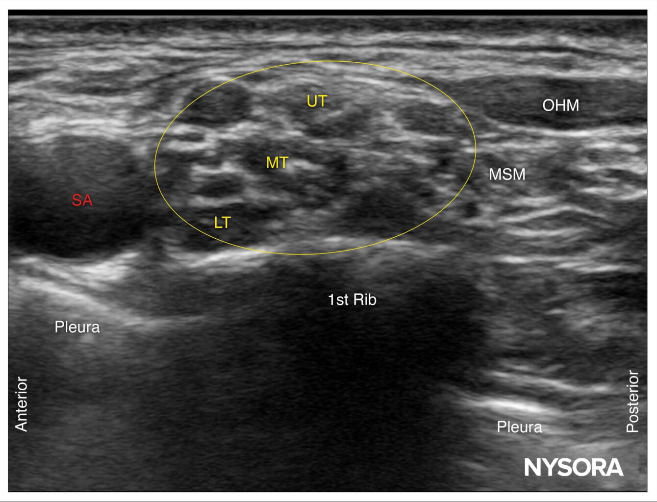 Ultrasound image — supraclavicular view showing brachial plexus trunks (UT, MT, LT), subclavian artery (SA), first rib, and pleura. NYSORA.